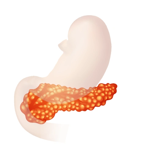 Inflammed-Pancreas Inflammed Pancreas